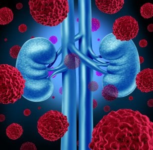 Kidney Cancer Risk Factors in Nashville